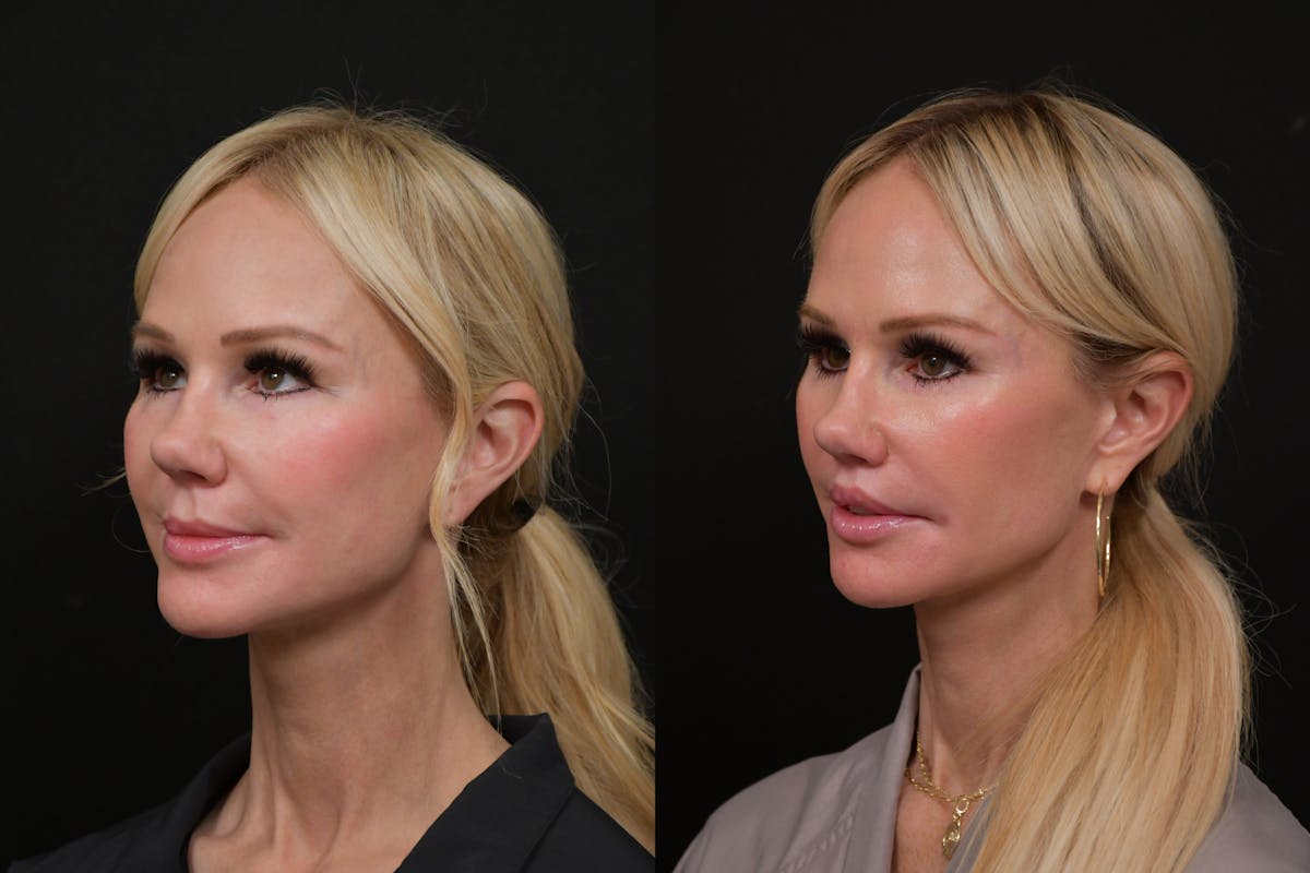 Lip Lift Before & After Gallery - Patient 366641 - Image 4