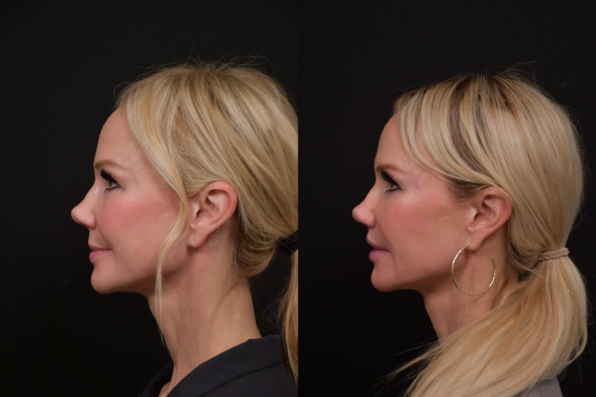 Lip Lift Before & After Gallery - Patient 366641 - Image 5