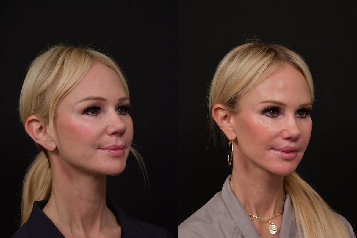 Lip Lift Before & After Gallery - Patient 366641 - Image 2