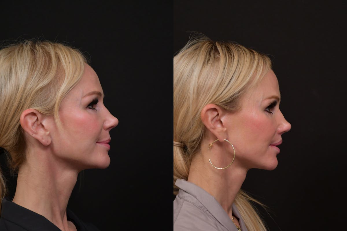 Lip Lift Before & After Gallery - Patient 366641 - Image 3