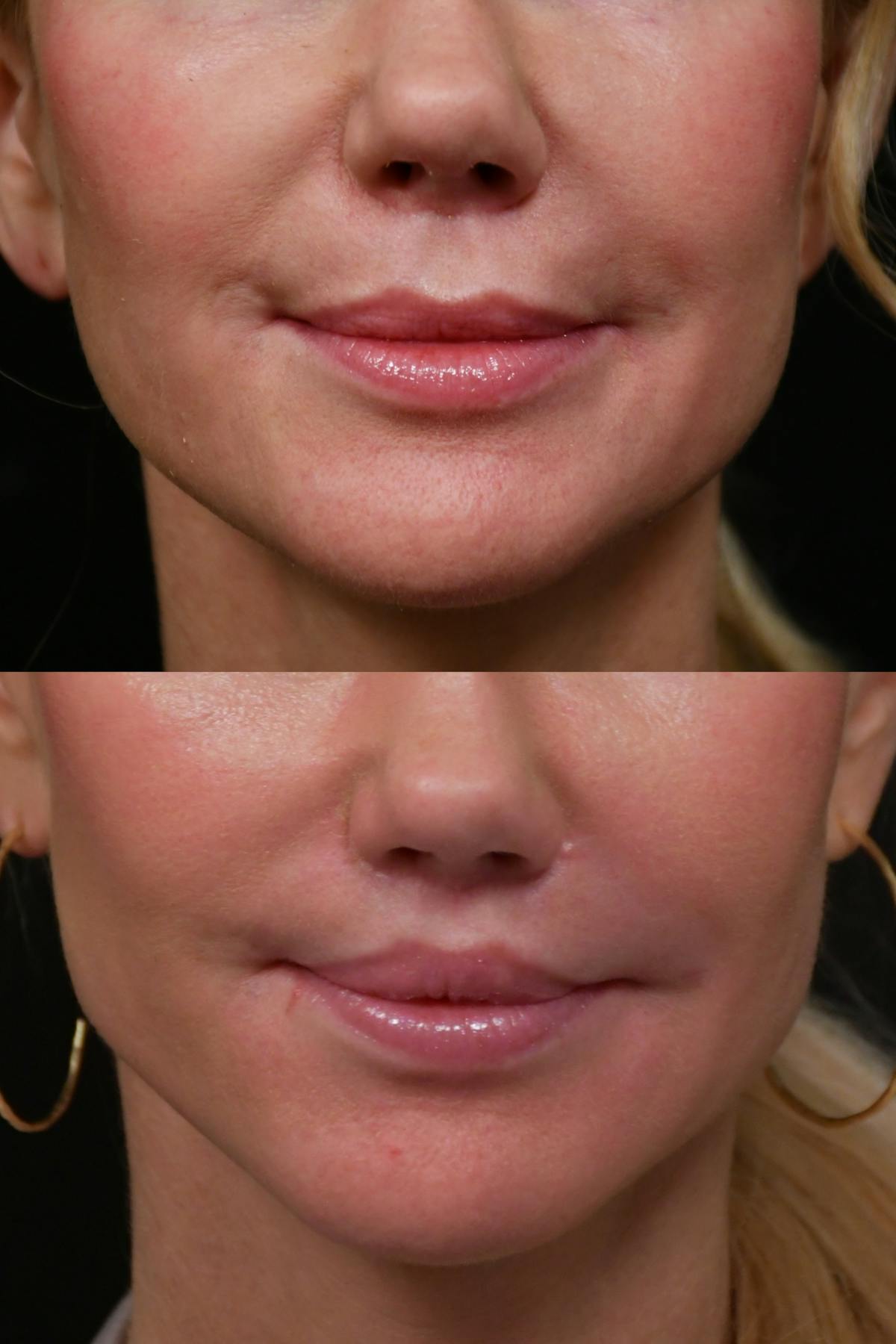 Lip Lift Before & After Gallery - Patient 366641 - Image 6