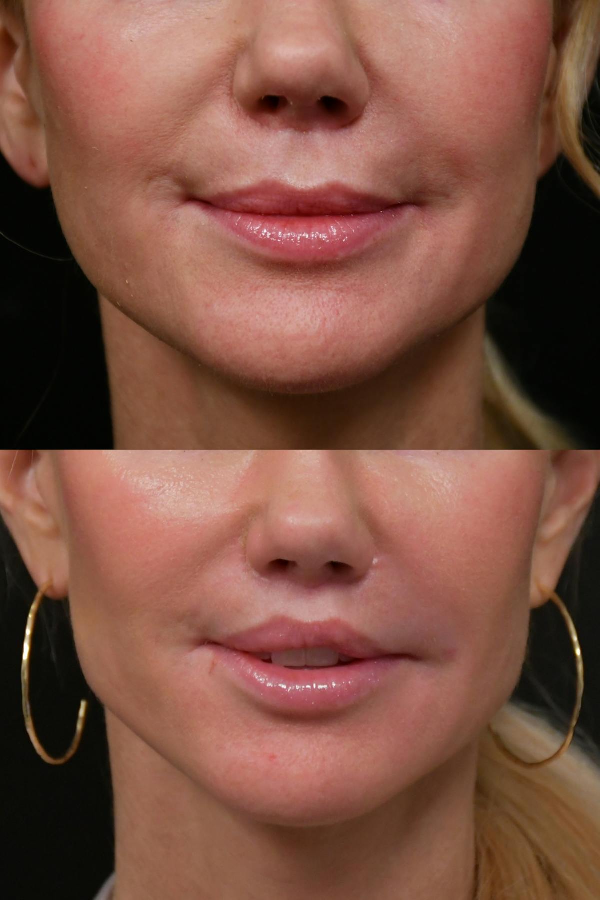 Lip Lift Before & After Gallery - Patient 366641 - Image 7