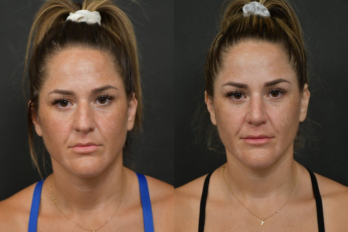 Rhinoplasty Before & After Gallery - Patient 211059 - Image 2