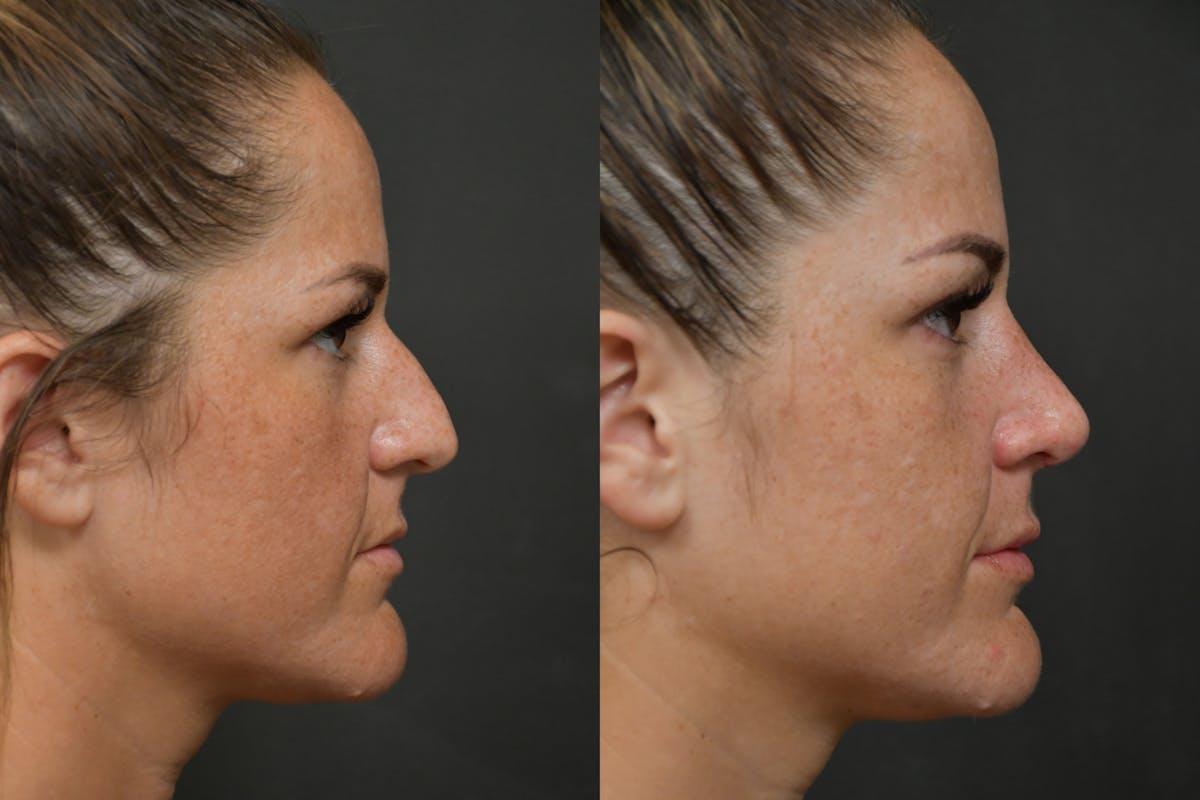 Rhinoplasty Before & After Gallery - Patient 211059 - Image 5