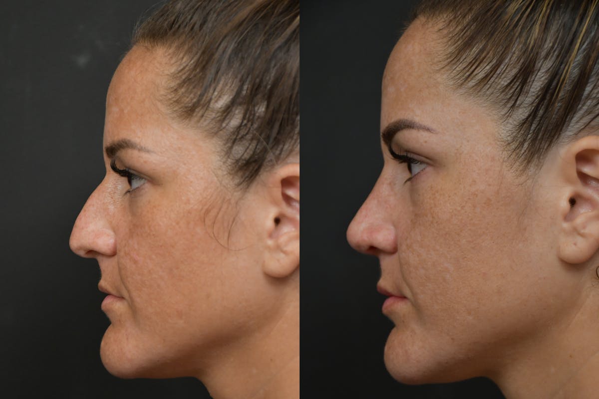 Rhinoplasty Before & After Gallery - Patient 211059 - Image 6