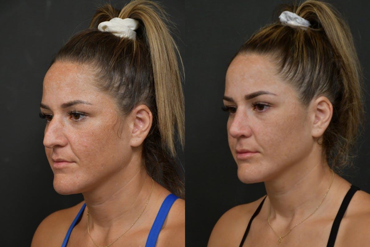 Rhinoplasty Before & After Gallery - Patient 211059 - Image 1
