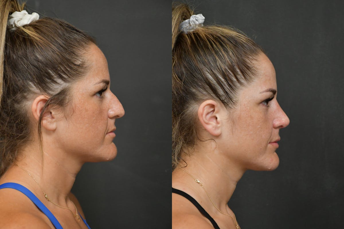Rhinoplasty Before & After Gallery - Patient 211059 - Image 4
