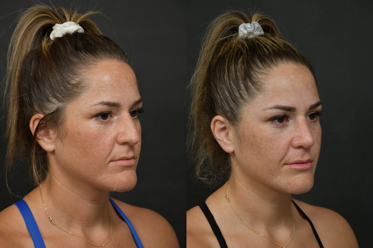 Rhinoplasty Before & After Gallery - Patient 211059 - Image 3