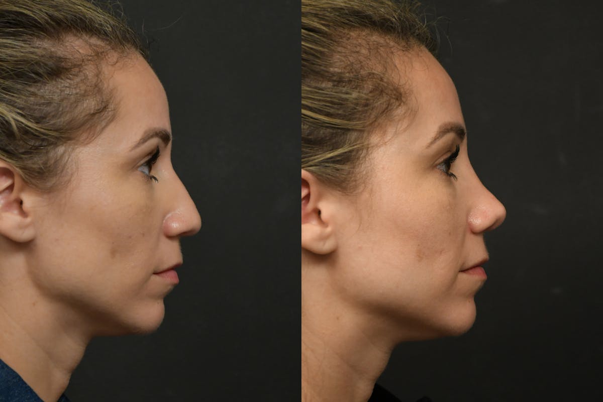 Rhinoplasty Before & After Gallery - Patient 903680 - Image 7