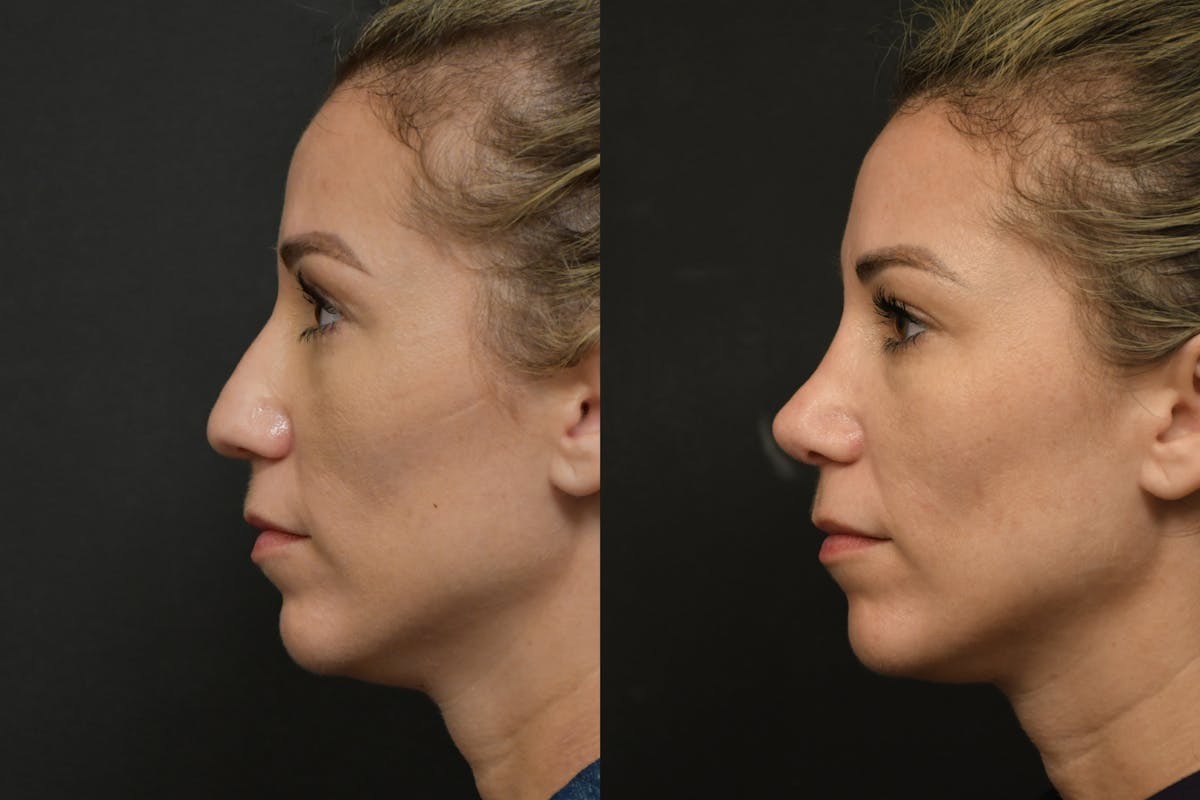 Rhinoplasty Before & After Gallery - Patient 903680 - Image 6