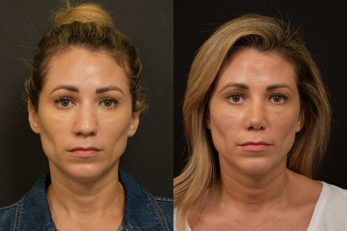 Rhinoplasty Before & After Gallery - Patient 903680 - Image 5