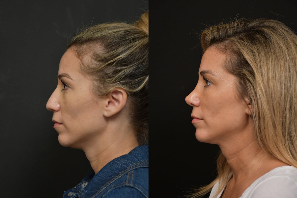 Rhinoplasty Before & After Gallery - Patient 903680 - Image 2