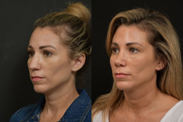 Rhinoplasty Before & After Gallery - Patient 903680 - Image 1