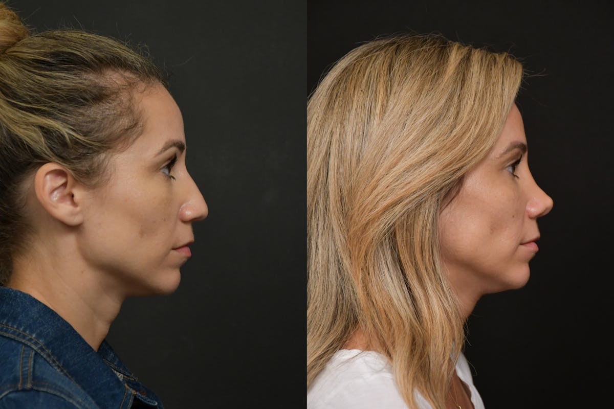 Rhinoplasty Before & After Gallery - Patient 903680 - Image 4