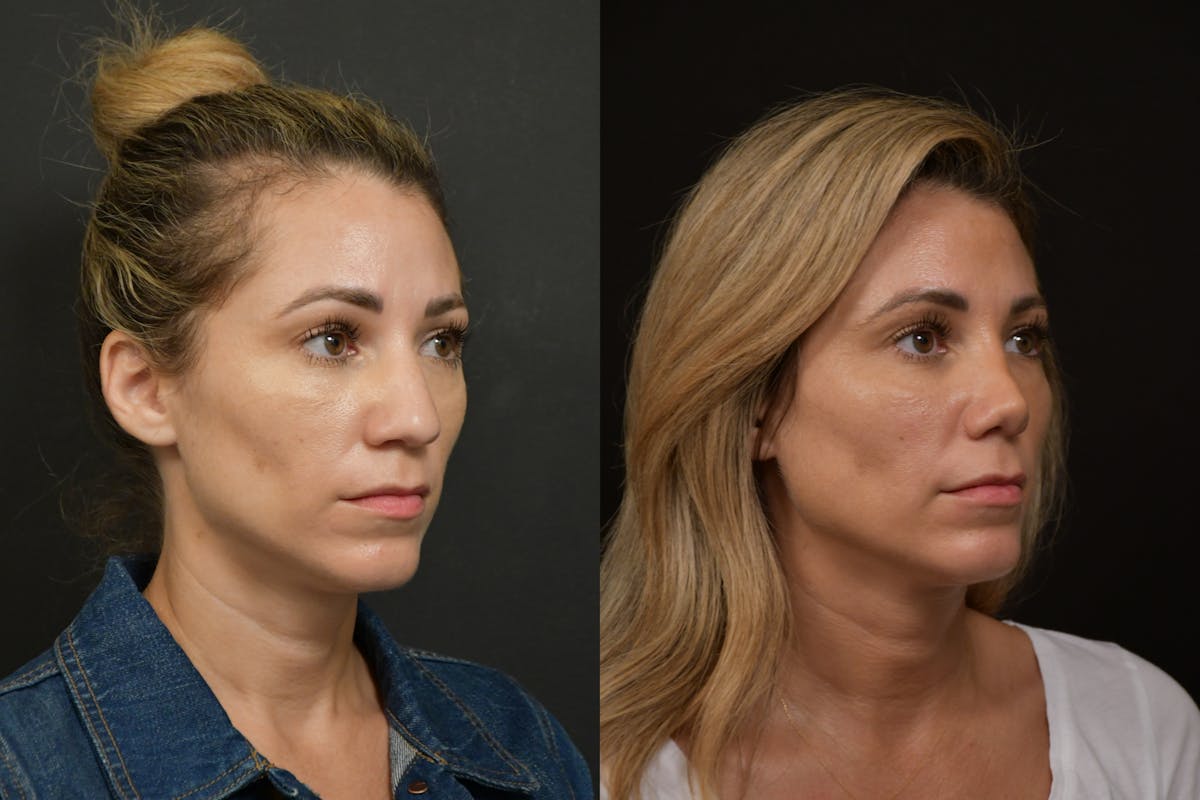 Rhinoplasty Before & After Gallery - Patient 903680 - Image 3