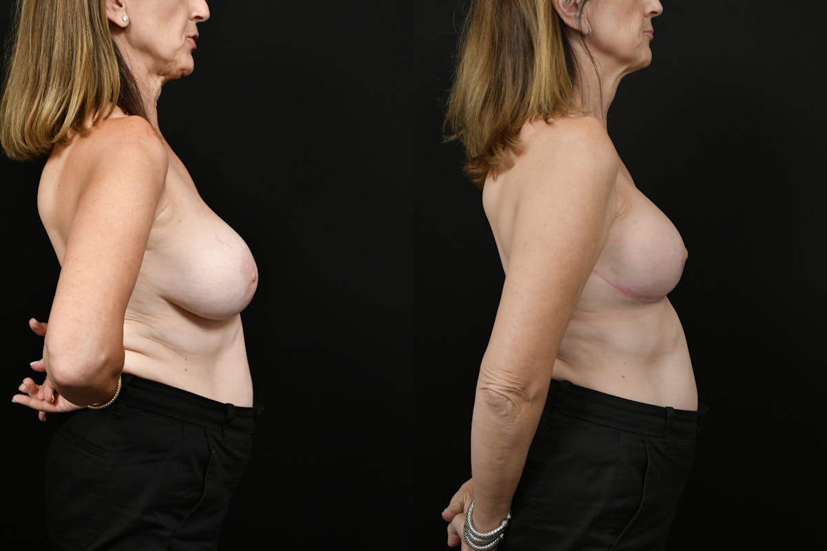 Reductive Augmentation Before & After Gallery - Patient 259359 - Image 3