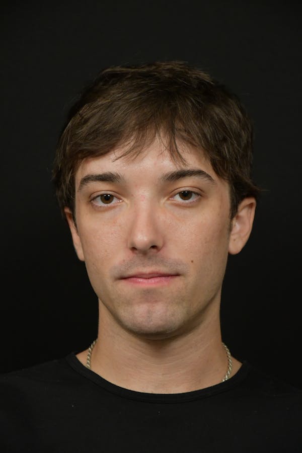 Skin Rejuvenation Before & After Gallery - Patient 314208 - Image 1