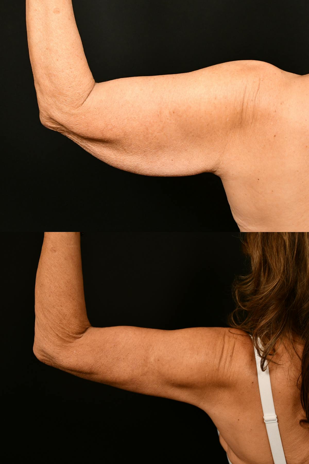Arm Lift Before & After Gallery - Patient 334386 - Image 7
