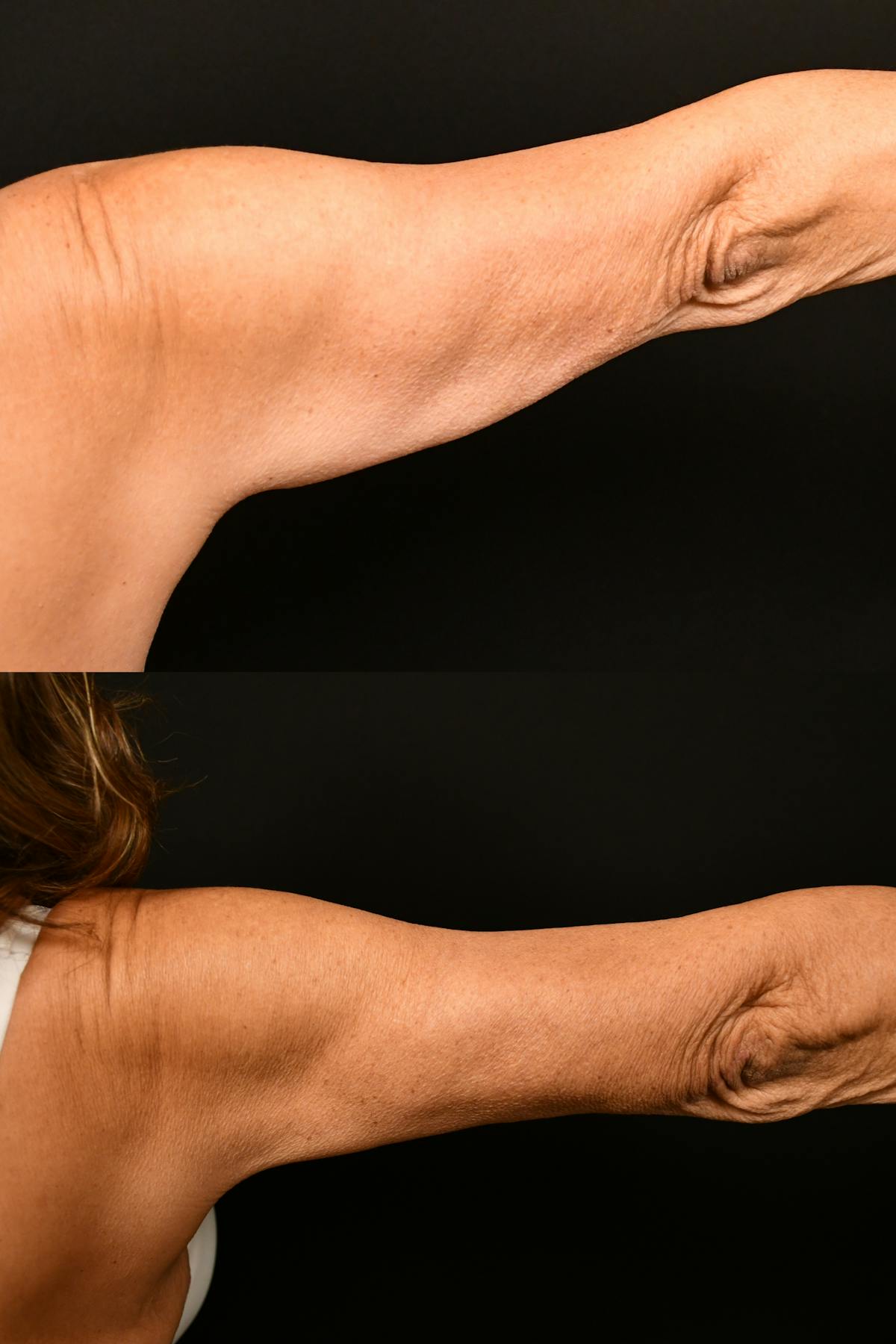 Arm Lift Before & After Gallery - Patient 334386 - Image 4