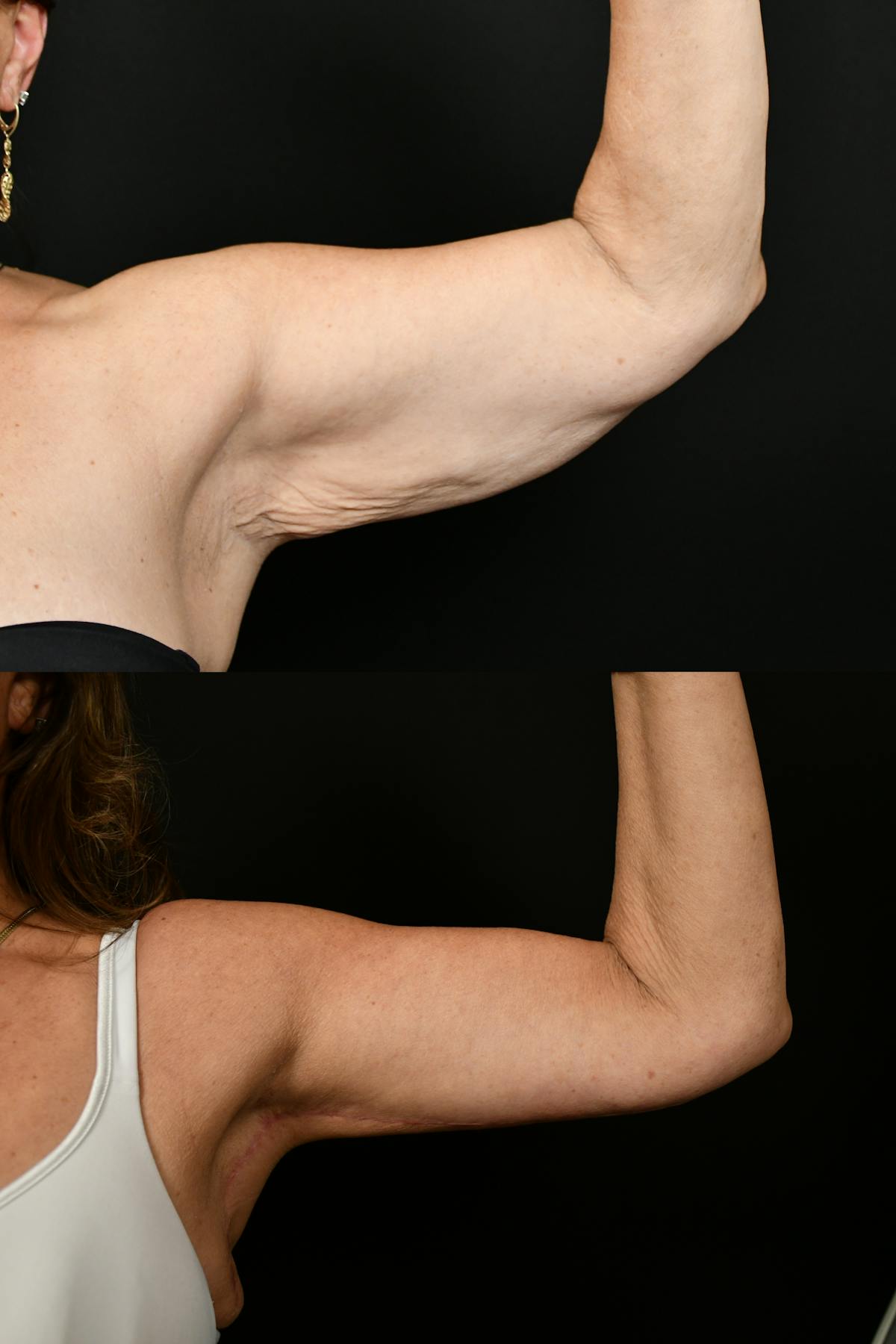 Arm Lift Before & After Gallery - Patient 334386 - Image 2