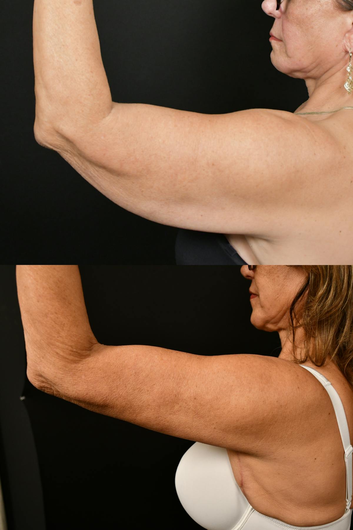 Arm Lift Before & After Gallery - Patient 334386 - Image 6