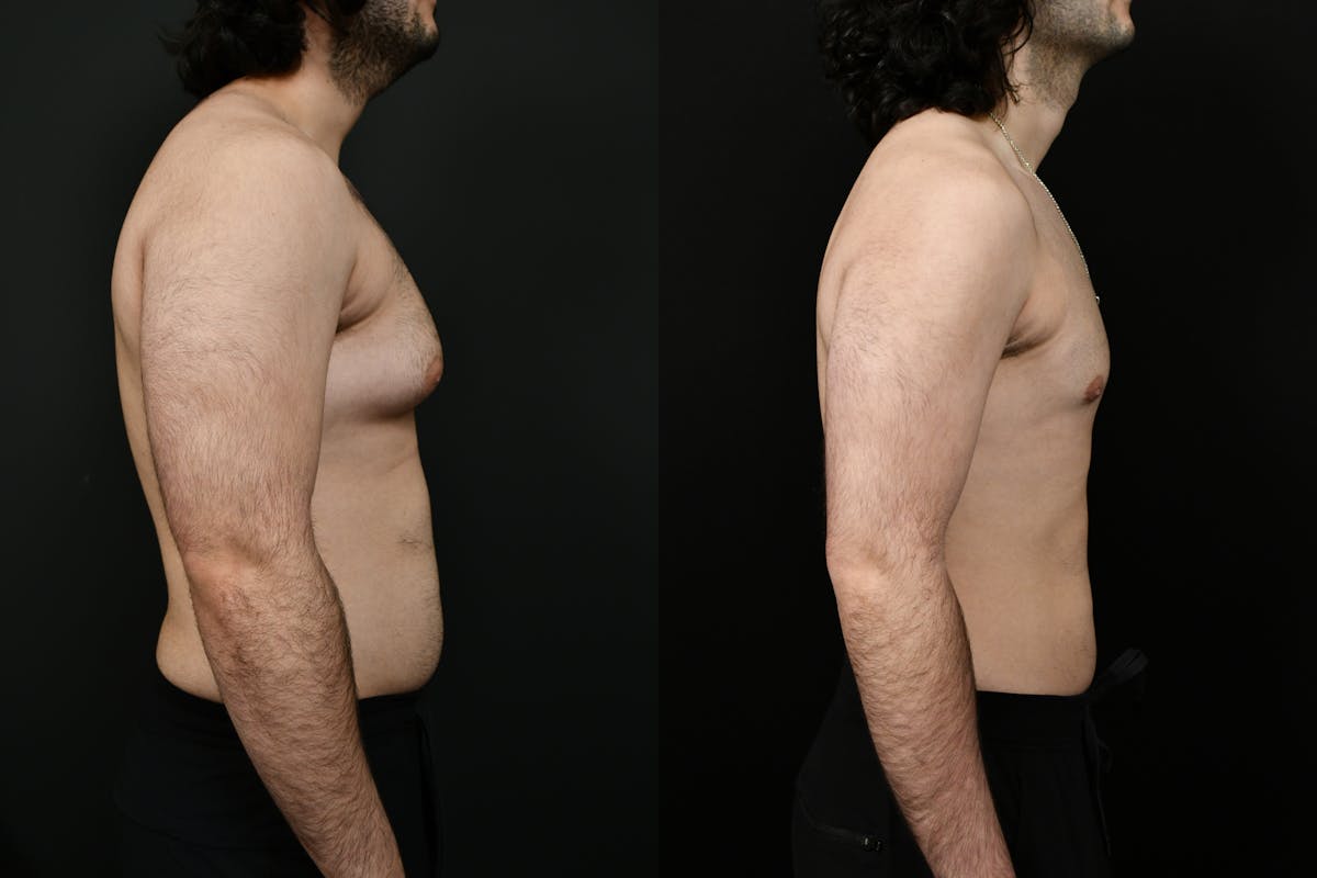 Gynecomastia Before & After Gallery - Patient 391542 - Image 3