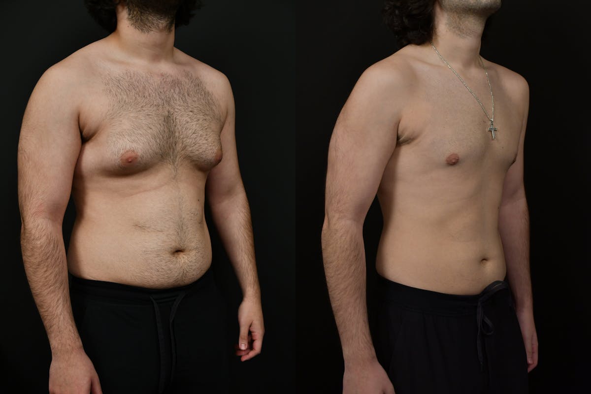Gynecomastia Before & After Gallery - Patient 391542 - Image 2