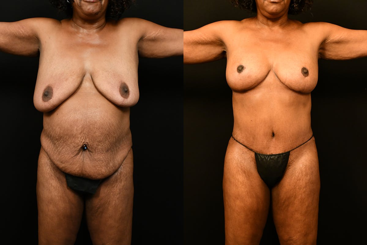 Mommy Makeover Before & After Gallery - Patient 988351 - Image 1