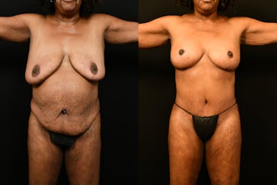 Mommy Makeover Before & After Gallery - Patient 988351 - Image 1
