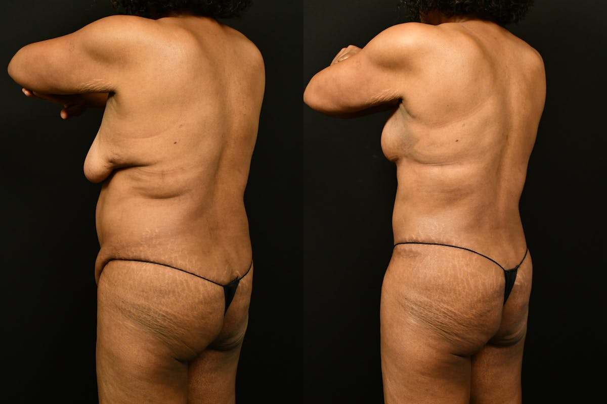 Mommy Makeover Before & After Gallery - Patient 988351 - Image 4