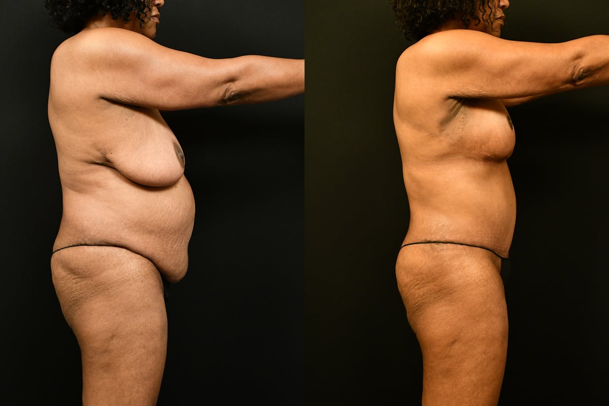 Mommy Makeover Before & After Gallery - Patient 988351 - Image 7