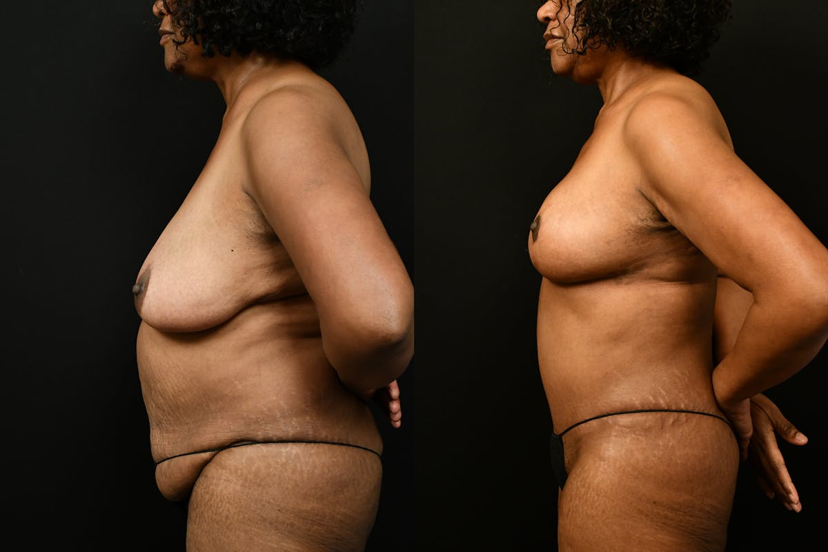 Tummy Tuck Before & After Gallery - Patient 355209 - Image 13