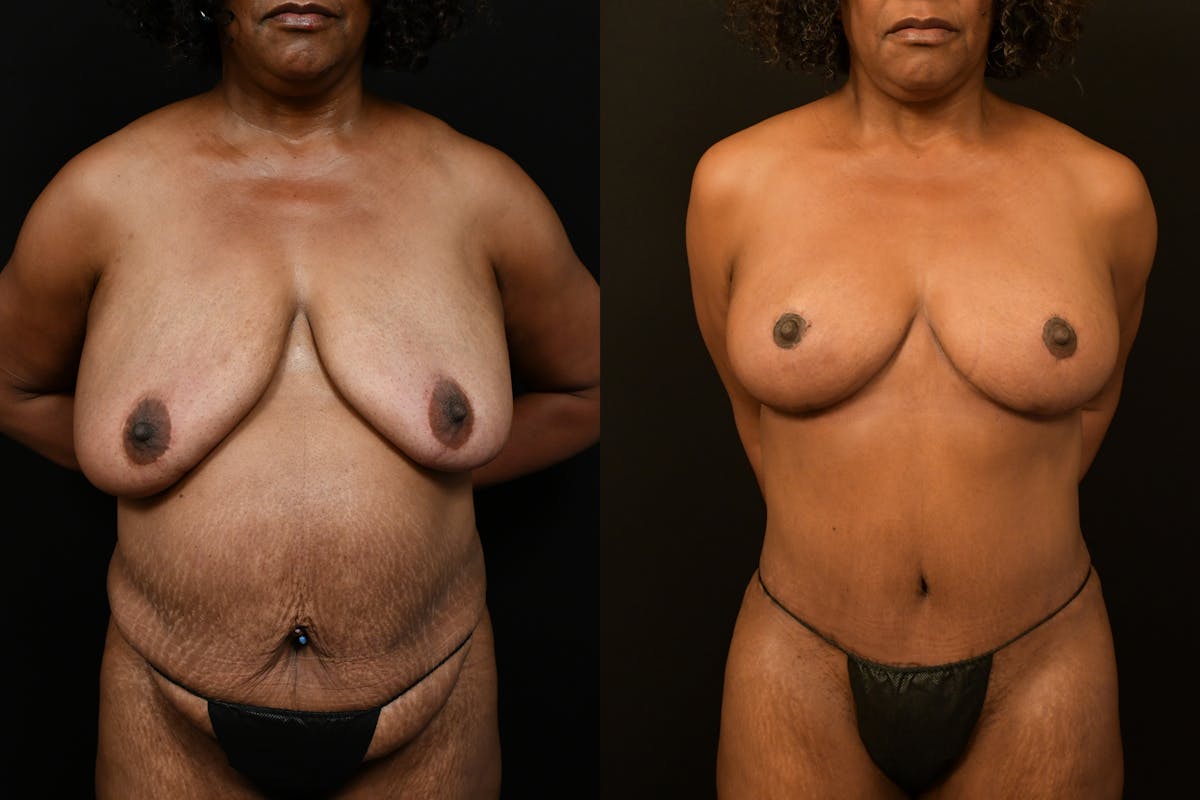 Tummy Tuck Before & After Gallery - Patient 355209 - Image 9