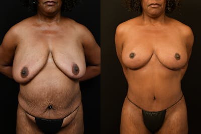 Breast Reduction Before & After Gallery - Patient 321080 - Image 1