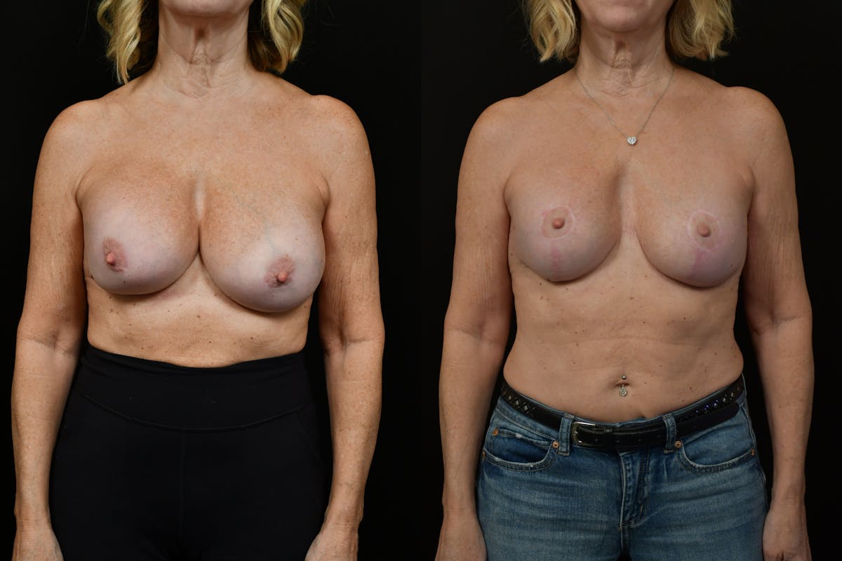 Reductive Augmentation Before & After Gallery - Patient 349280 - Image 6