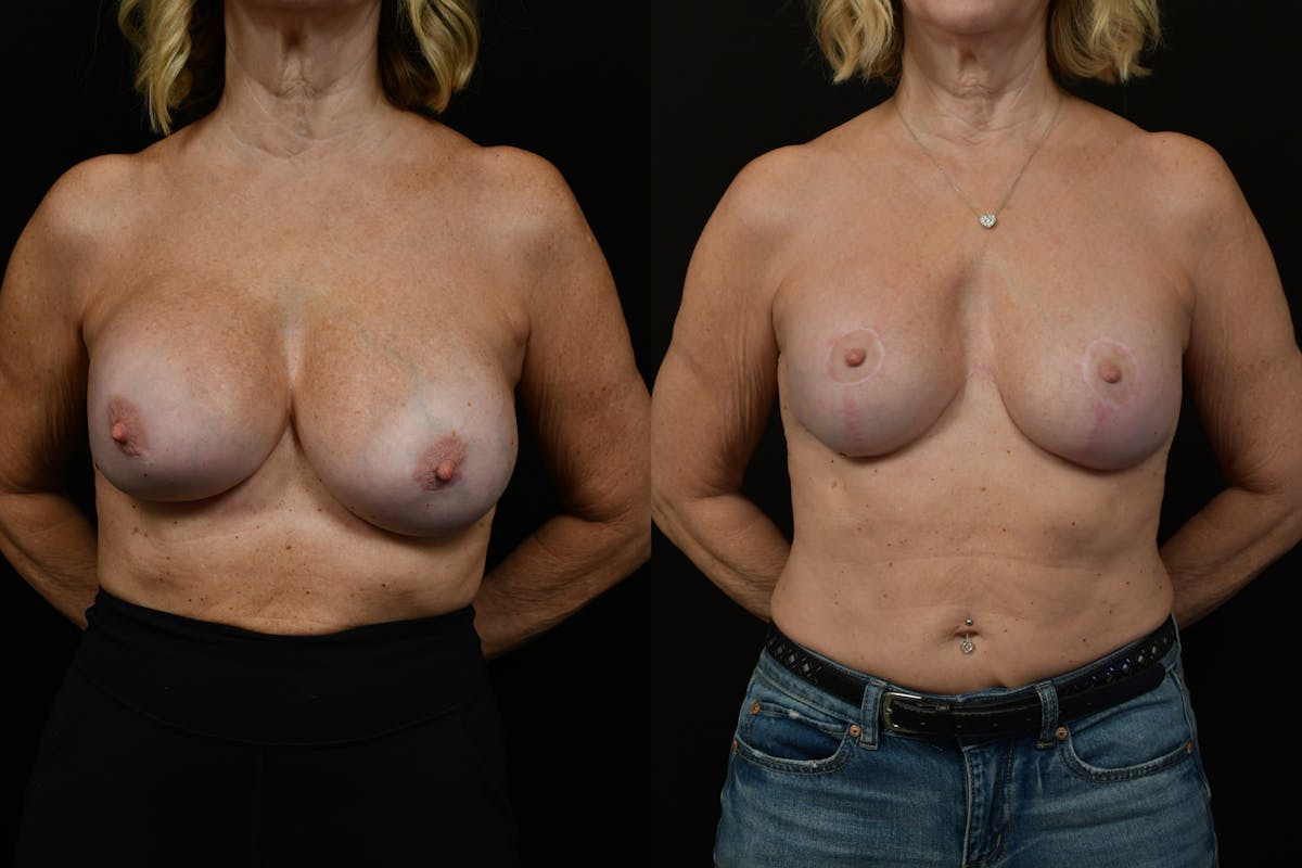 Reductive Augmentation Before & After Gallery - Patient 349280 - Image 1