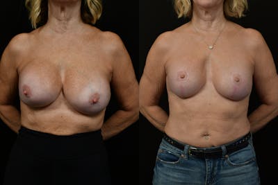 Breast Revision Before & After Gallery - Patient 106852 - Image 1