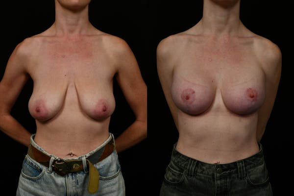 Breast Augmentation Before & After Gallery - Patient 243335 - Image 1