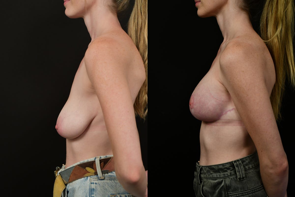 Breast Lift Before & After Gallery - Patient 108112 - Image 5
