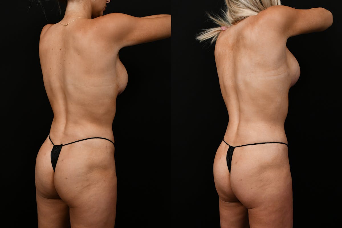 Mommy Makeover Before & After Gallery - Patient 137086 - Image 4