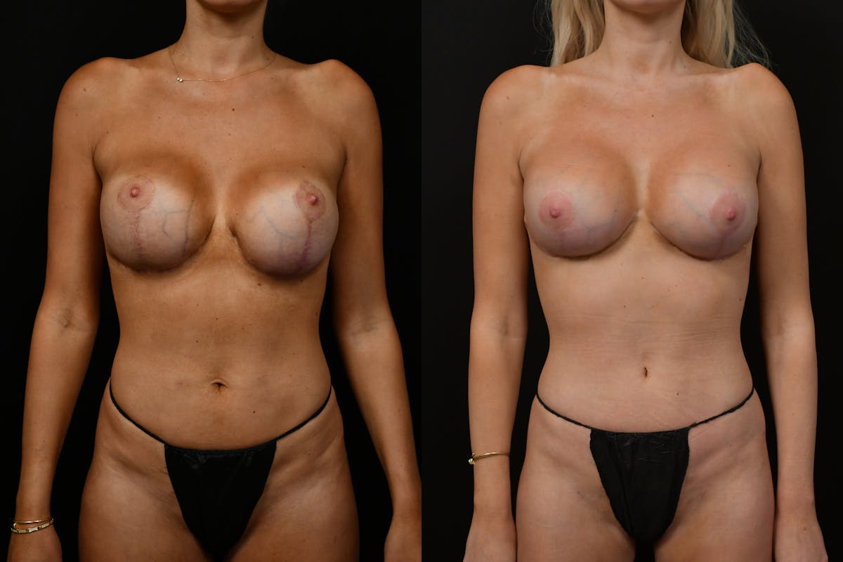 Mommy Makeover Before & After Gallery - Patient 137086 - Image 14