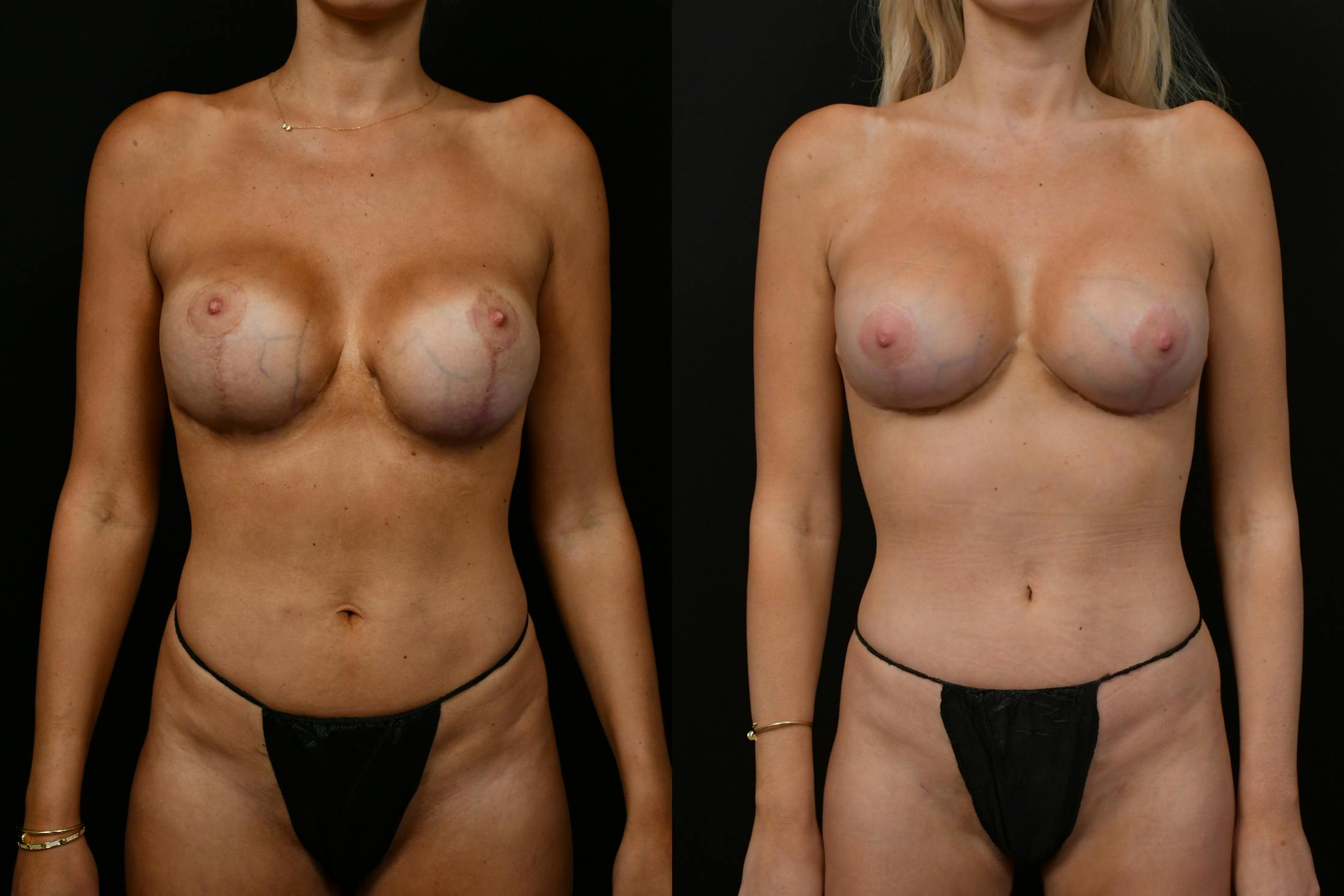 Mommy Makeover Before & After Gallery - Patient 137086 - Image 14