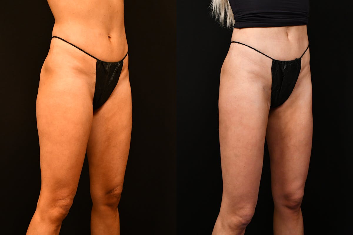 Liposuction / BodyTite Before & After Gallery - Patient 136742 - Image 2