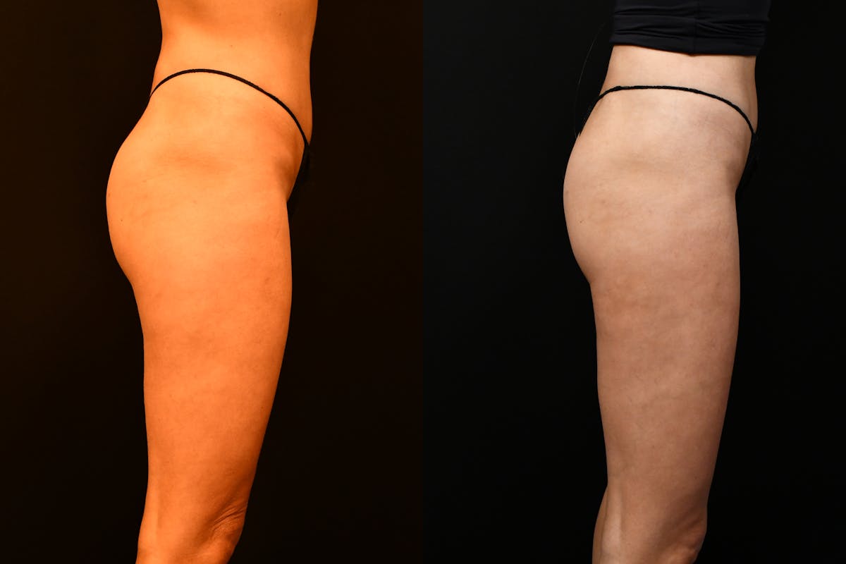 Liposuction / BodyTite Before & After Gallery - Patient 136742 - Image 3
