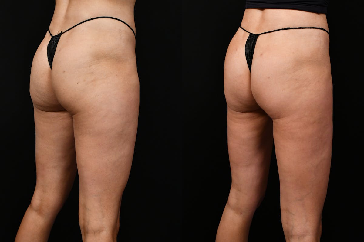 Liposuction / BodyTite Before & After Gallery - Patient 136742 - Image 4