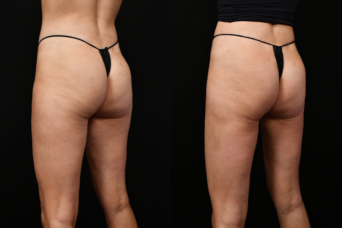 Liposuction / BodyTite Before & After Gallery - Patient 136742 - Image 6
