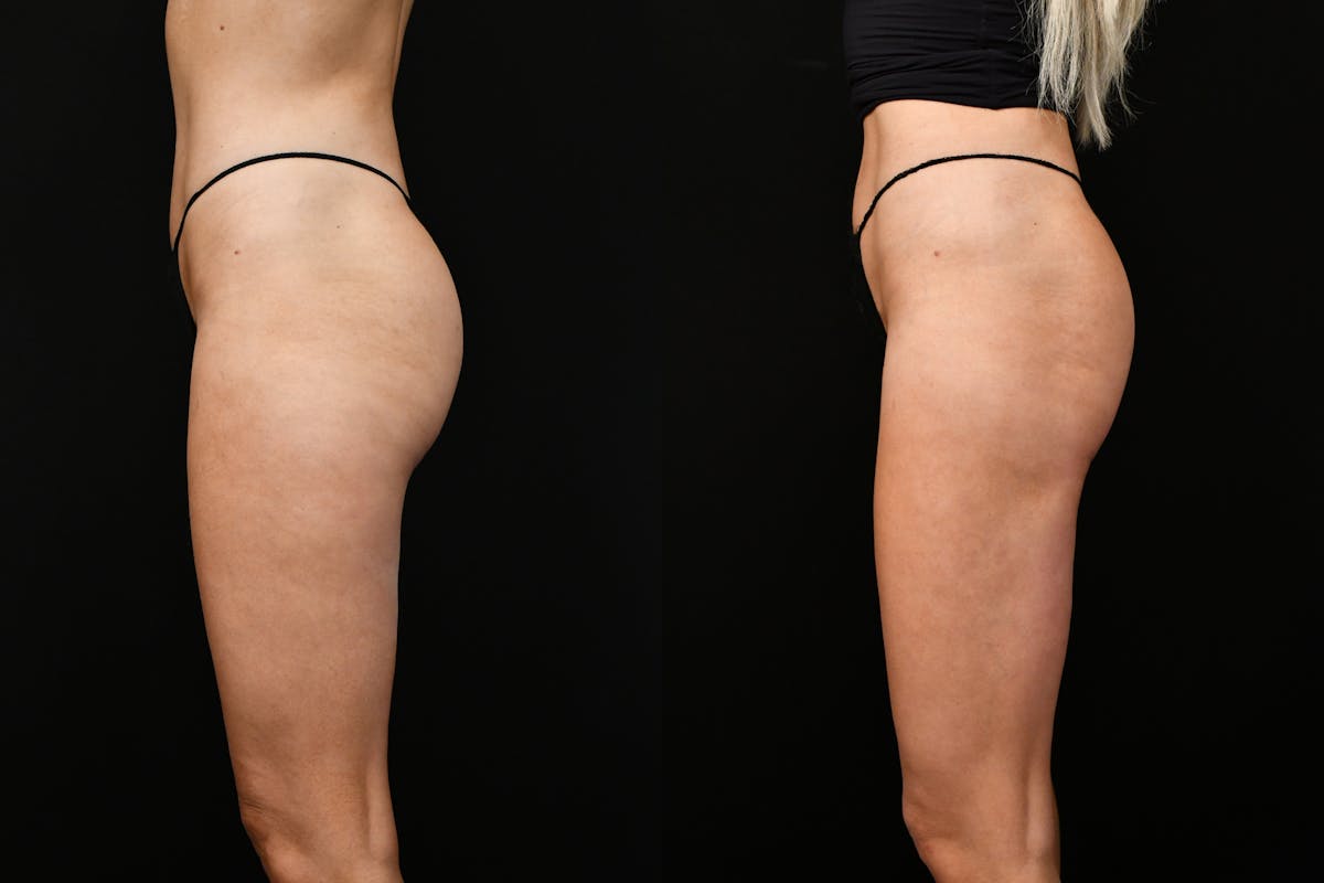 Liposuction / BodyTite Before & After Gallery - Patient 136742 - Image 7