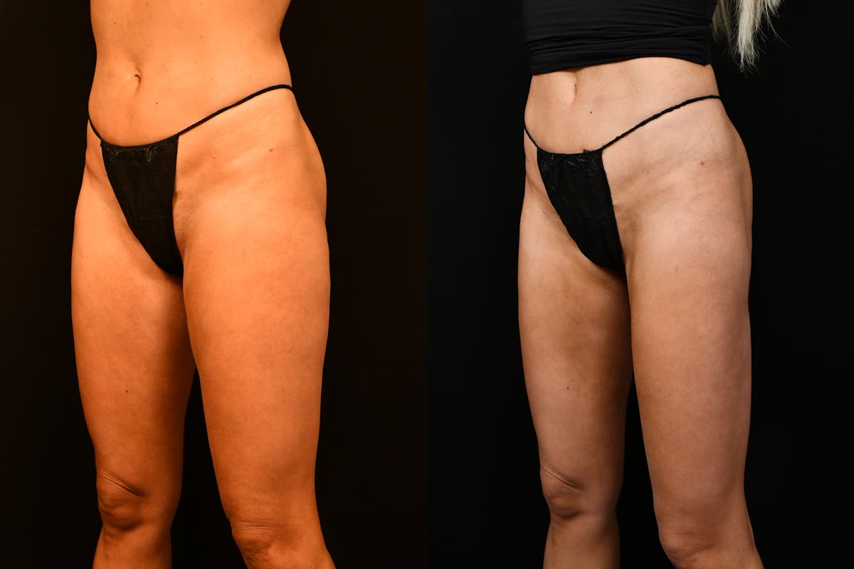 Liposuction / BodyTite Before & After Gallery - Patient 136742 - Image 8
