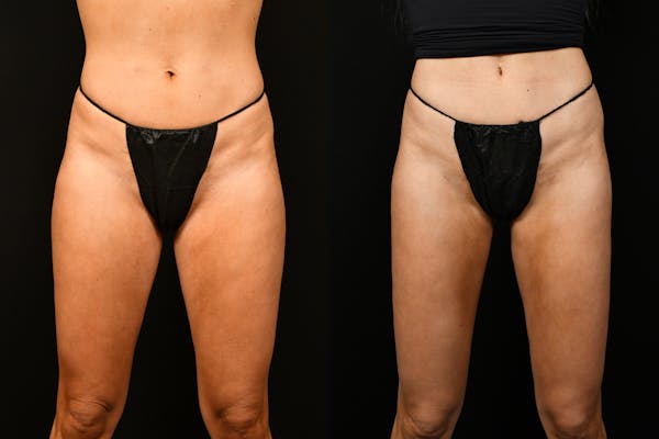 Liposuction / BodyTite Before & After Gallery - Patient 136742 - Image 1
