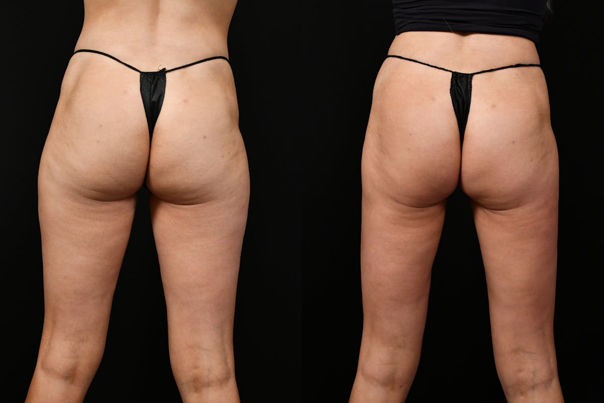 Liposuction / BodyTite Before & After Gallery - Patient 136742 - Image 5